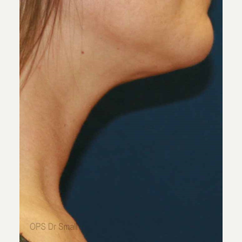45-54 year old woman treated with Liposuction after 3305965