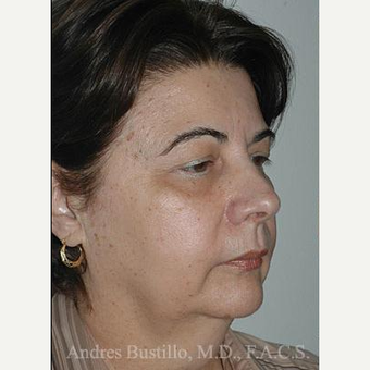 58 year old woman treated with Facelift before 3486348