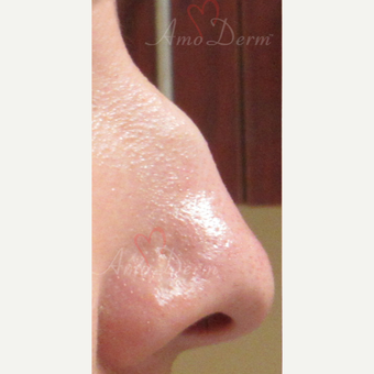 25-34 year old woman treated with Non Surgical Nose Job before 3381453