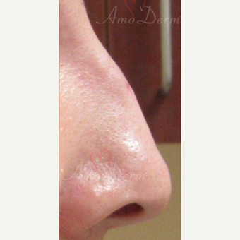 25-34 year old woman treated with Non Surgical Nose Job after 3381453