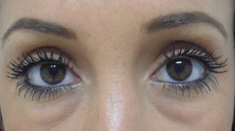 PeriOrbital Facial Filler 28 years old before 1125247