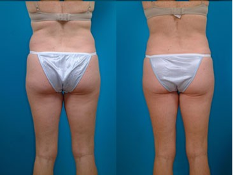 39-year-old woman treated with Liposuction. after 574496
