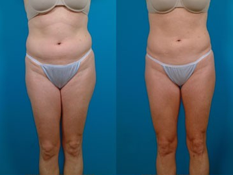 39-year-old woman treated with Liposuction. before 574496