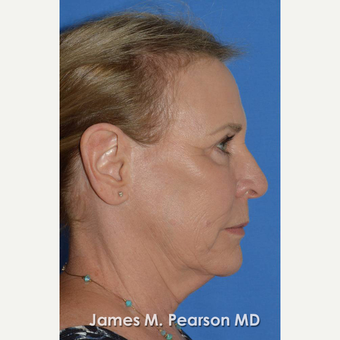 55-64 year old woman treated with Facelift before 3802266