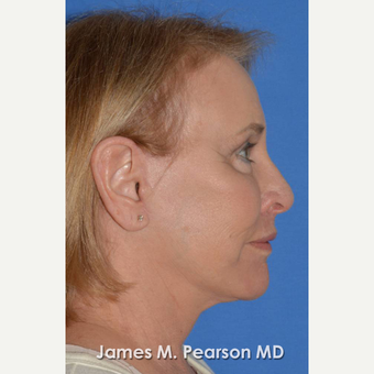 55-64 year old woman treated with Facelift after 3802266