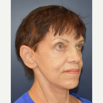 65-74 year old woman treated with Neck Lift after 3449116