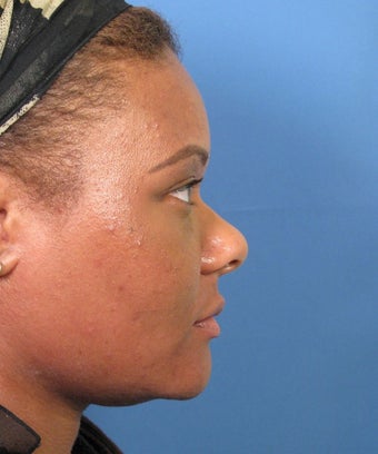 African-American Rhinoplasty 1694529