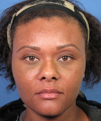 African-American Rhinoplasty before 1694529