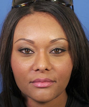 African-American Rhinoplasty after 1694529