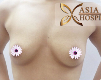 18-24 year old woman treated with Breast Augmentation before 3765982