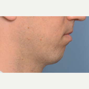 35-44 year old man treated with Chin Surgery before 3360989