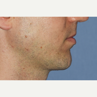 35-44 year old man treated with Chin Surgery after 3360989