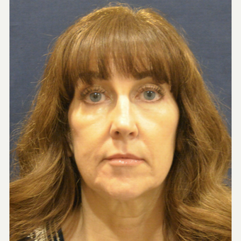 55-64 year old woman treated with Facelift before 3726948