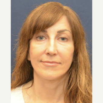 55-64 year old woman treated with Facelift after 3726948