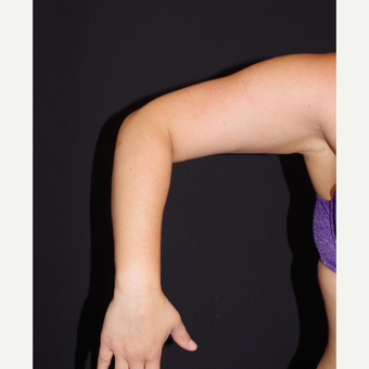 25-34 year old woman treated with Smart Lipo before 2998835