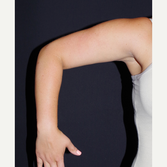 25-34 year old woman treated with Smart Lipo after 2998835