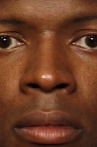 Rhinoplasty after 339214