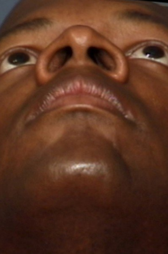 Rhinoplasty 339214