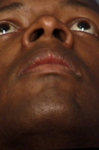 Rhinoplasty 339214