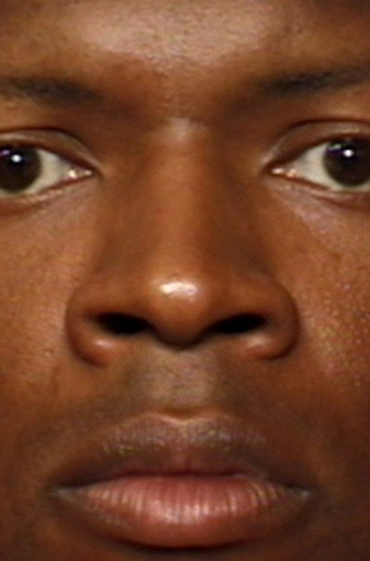 Rhinoplasty before 339214