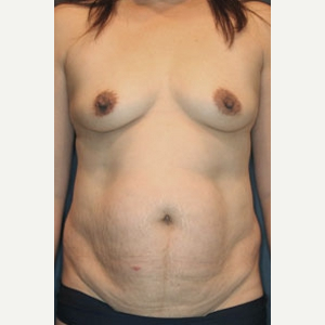 45-54 year old woman treated with Mommy Makeover before 3519830