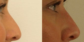 Rhinoplasty without surgery before 1011541