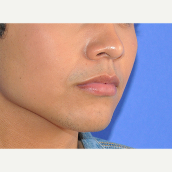 18-24 year old man treated with Lip Augmentation before 3219216
