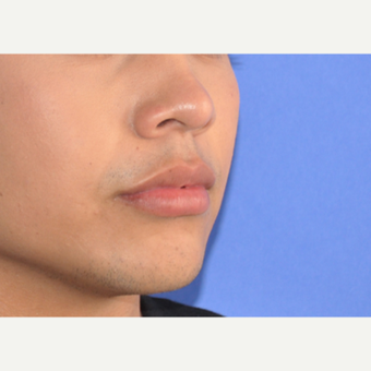 18-24 year old man treated with Lip Augmentation after 3219216