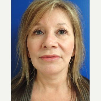 45-54 year old woman treated with Facelift after 2618415