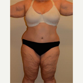 45-54 year old woman treated with Tummy Tuck after 3658166