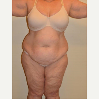 45-54 year old woman treated with Tummy Tuck before 3658166