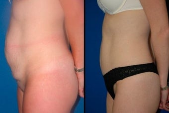 Tummy Tuck before 3054070