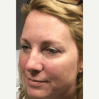 35-44 year old woman treated with Restylane Lyft after 2893963