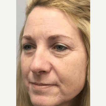 35-44 year old woman treated with Restylane Lyft before 2893963