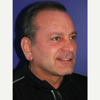 64 year old man treated with Facelift after 3710819
