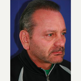 64 year old man treated with Facelift before 3710819