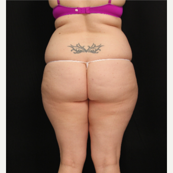 32 year old female with liposuction of abdomen and hips before 3576116
