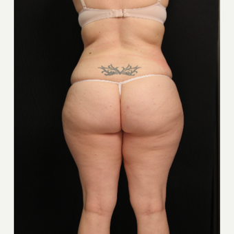 32 year old female with liposuction of abdomen and hips after 3576116