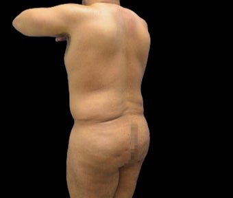 35-44 year old man treated with Body Jet before 3220610