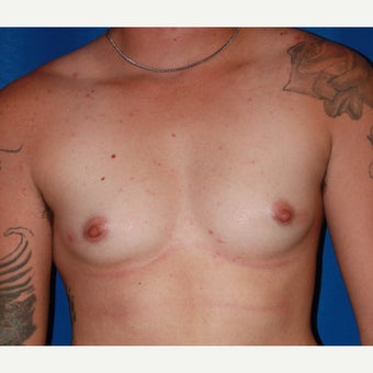 18-24 year old man treated with FTM Chest Masculinization Surgery before 2115543