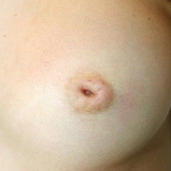 18-24 year old woman treated with Nipple Surgery before 1858404