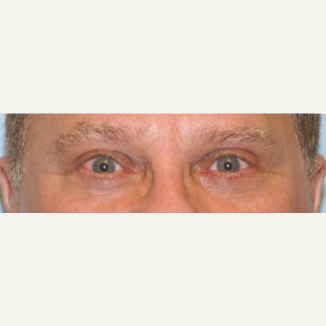 45-54 year old man treated with Ptosis Surgery after 3727876