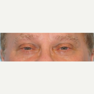 45-54 year old man treated with Ptosis Surgery before 3727876