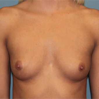 28 year old woman treated with Silicone Breast Implants before 3465208