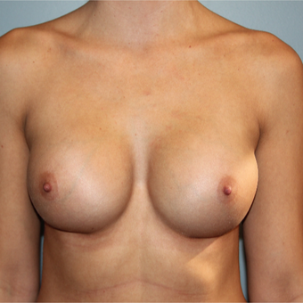 28 year old woman treated with Silicone Breast Implants after 3465208