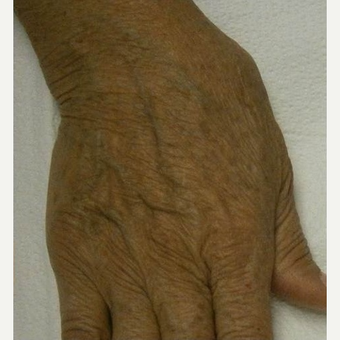 65-74 year old woman treated with IPL after 3120428