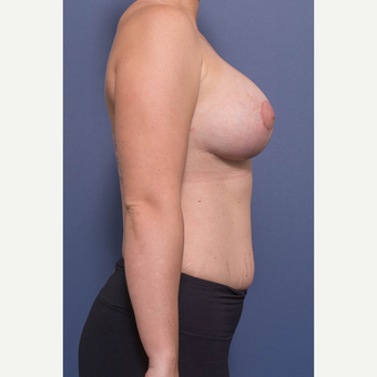 25-34 year old woman treated with Breast Lift with Implants after 3735151