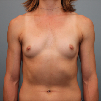 Silicone Breast Implants before 3390903