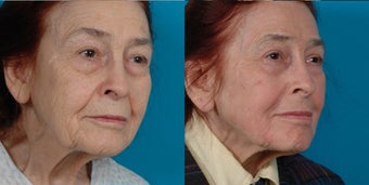 82-year-old woman treated with Juvéderm. after 3287689