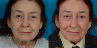 82-year-old woman treated with Juvéderm. before 3287689